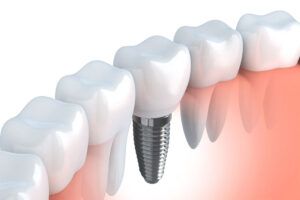 Dental Implants