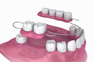 Dental Dentures and Partials