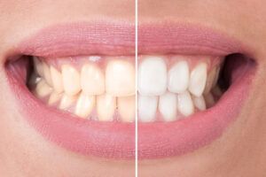 Teeth Whitening Before and After