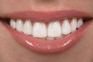 Veneers