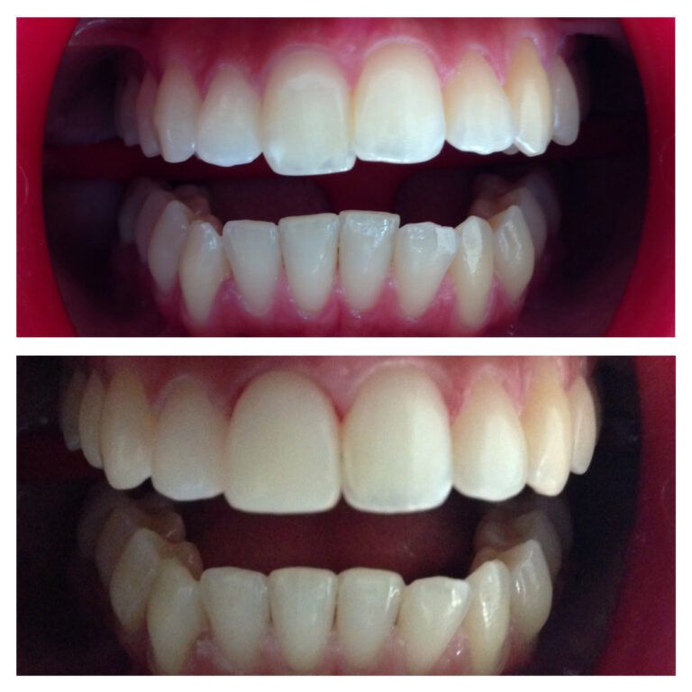 Composite Restoration: Before & After treatment - Patient 6