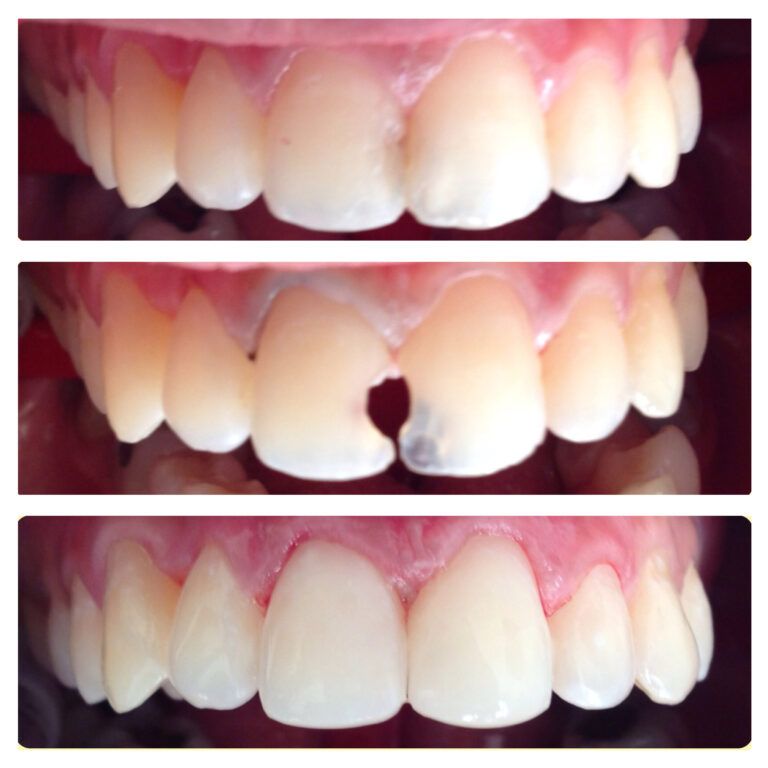 Composite Restoration: Before & After treatment - Patient 1