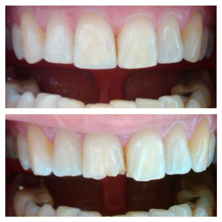 Composite Restoration: Before & After treatment Patient 2