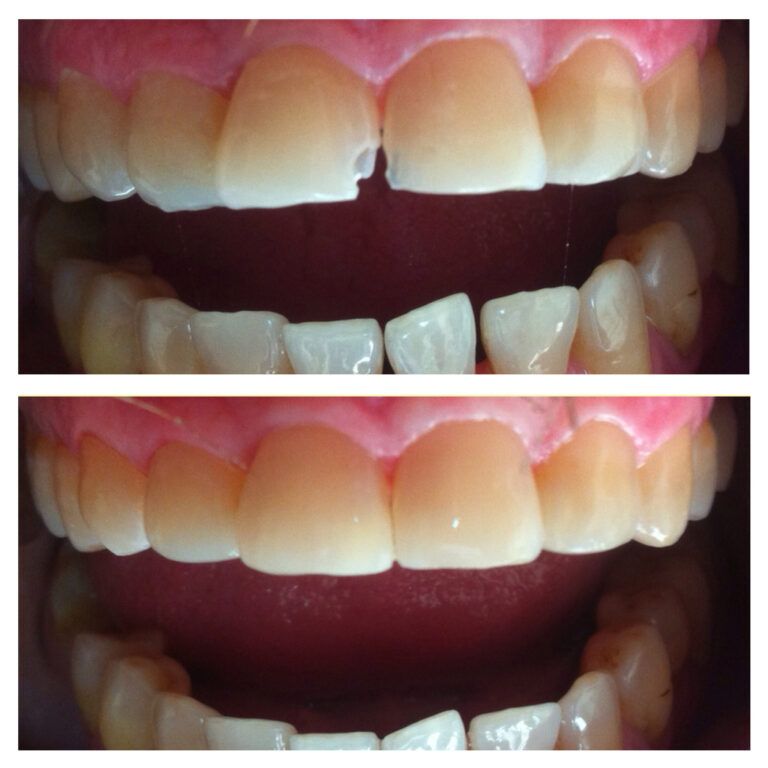 Composite Restoration: Before & After treatment - Patient 3