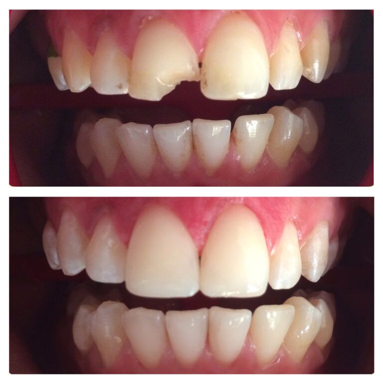 Composite Restoration: Before & After treatment - Patient 4