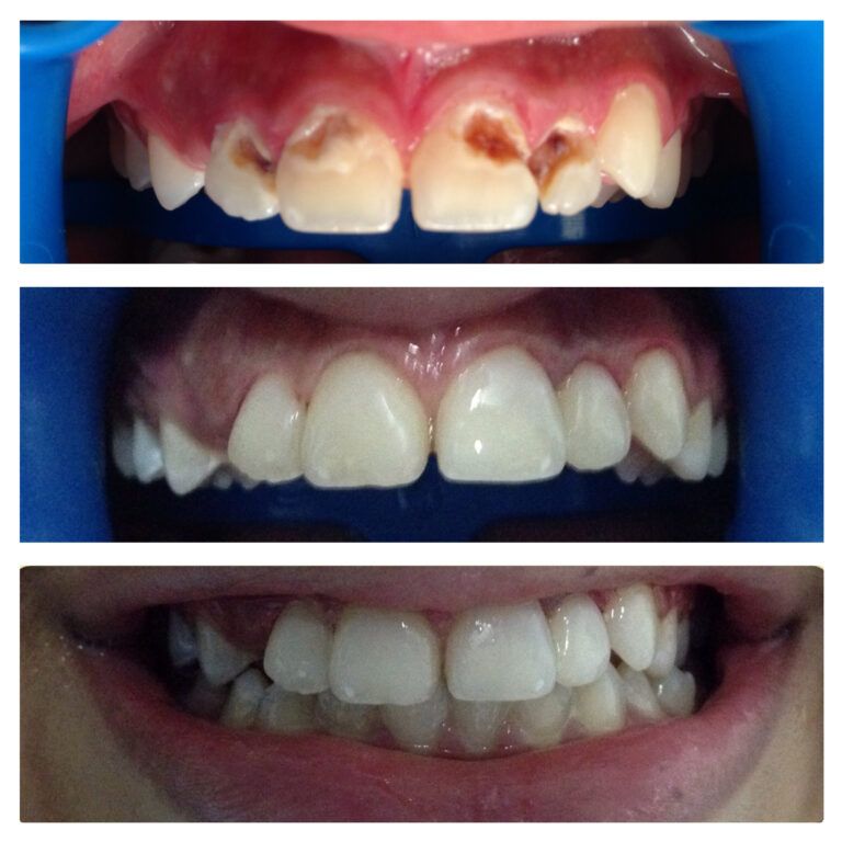 Composite Restoration: Before & After treatment - Patient 5