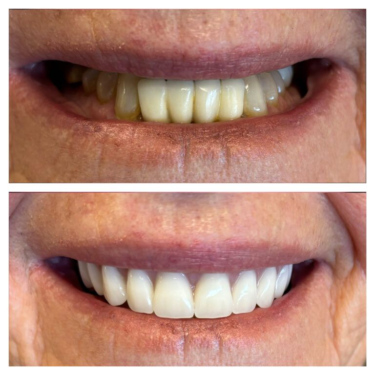 Complete Dentures: Before & After treatment