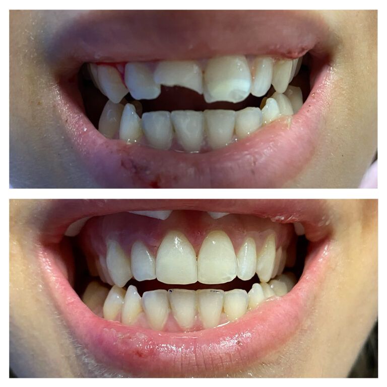 Crowns: Before & After treatment Patient 1