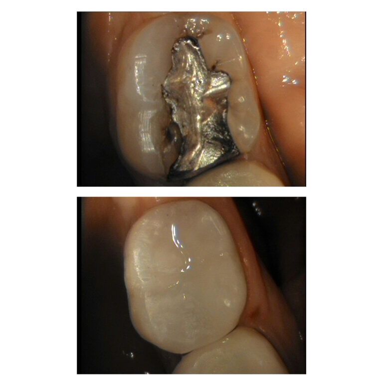 Crowns: Before & After treatment Patient 2