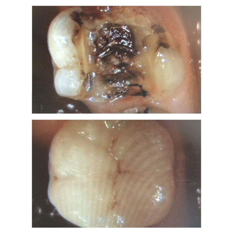 Crowns: Before & After treatment Patient 3