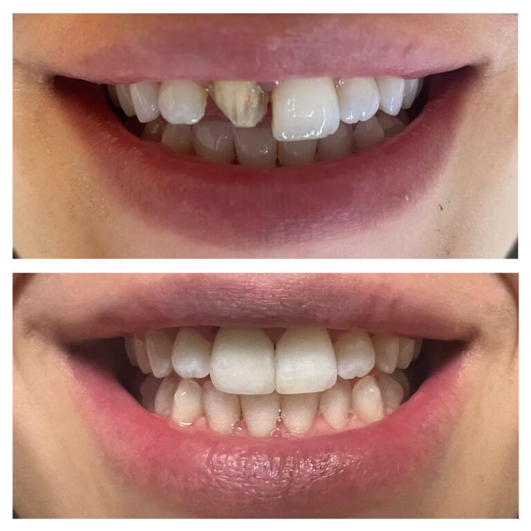 Crowns: Before & After treatment Patient 4