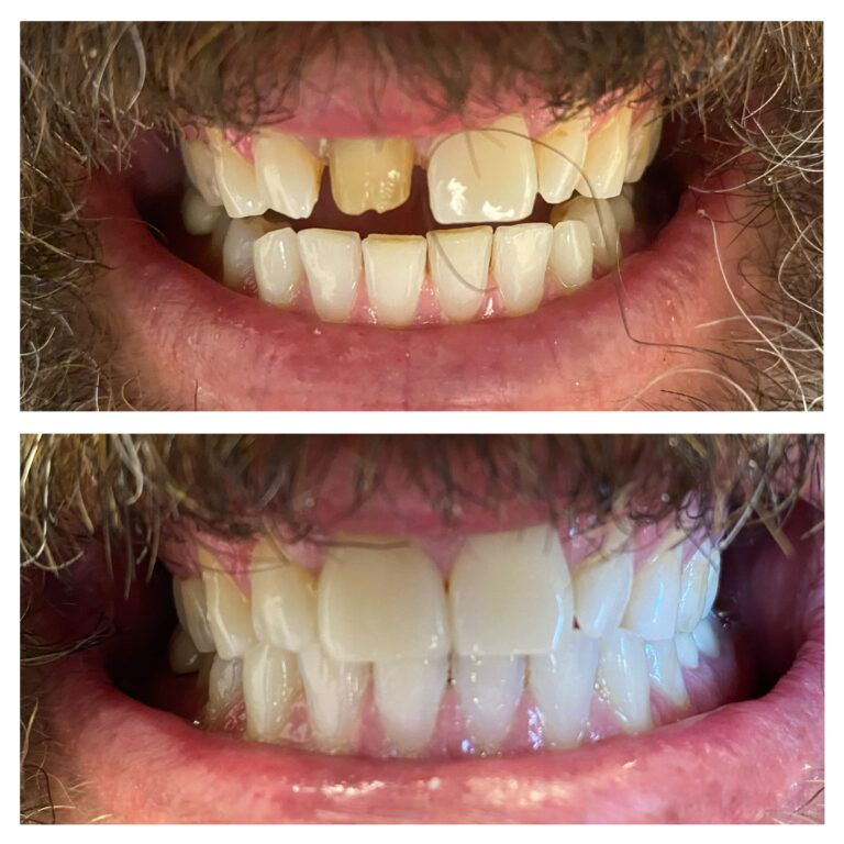 Crowns: Before & After treatment Patient 5