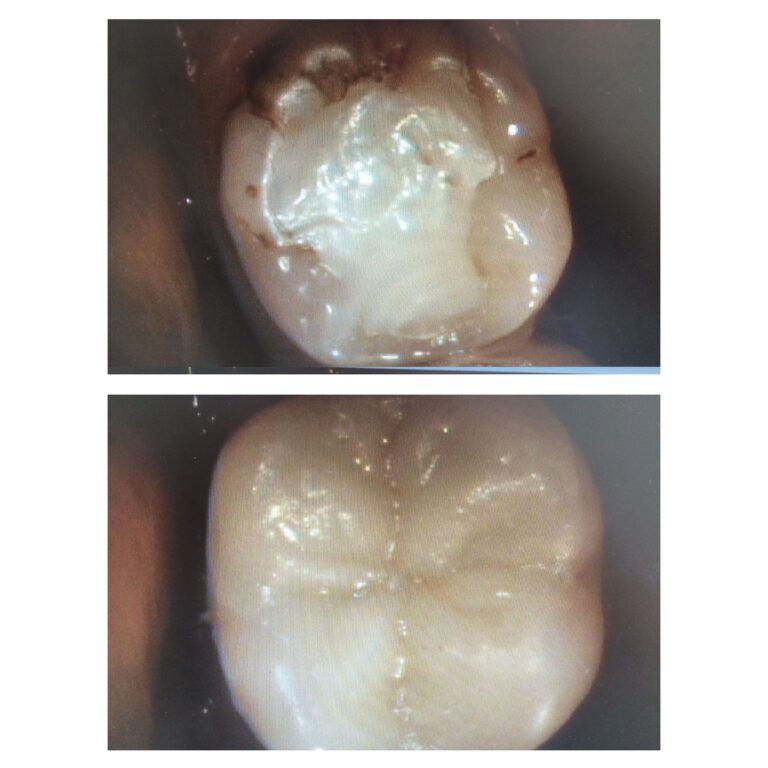 Crowns: Before & After treatment Patient 8