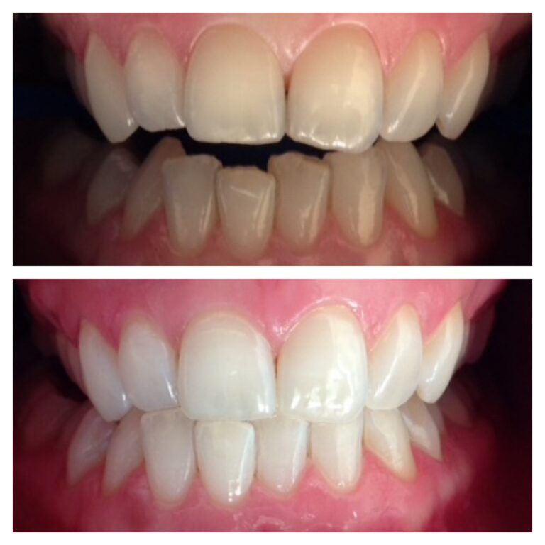 Teeth Bleaching: Before & After treatment - Patient 1