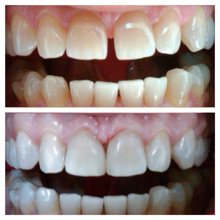 Teeth Bleaching: Before & After treatment - Patient 2