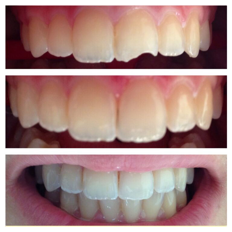 Teeth Bleaching: Before & After treatment - Patient 3