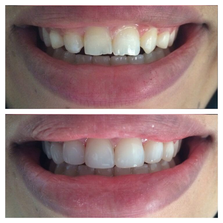 Veneers: Before & After treatment