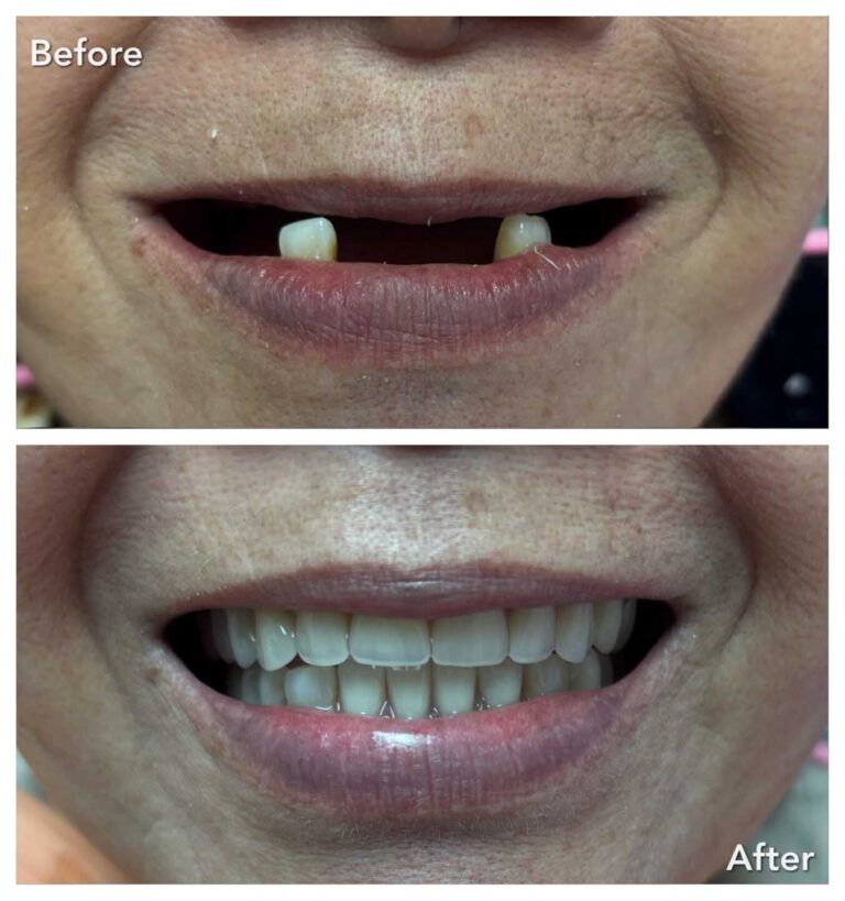 Complete Dentures