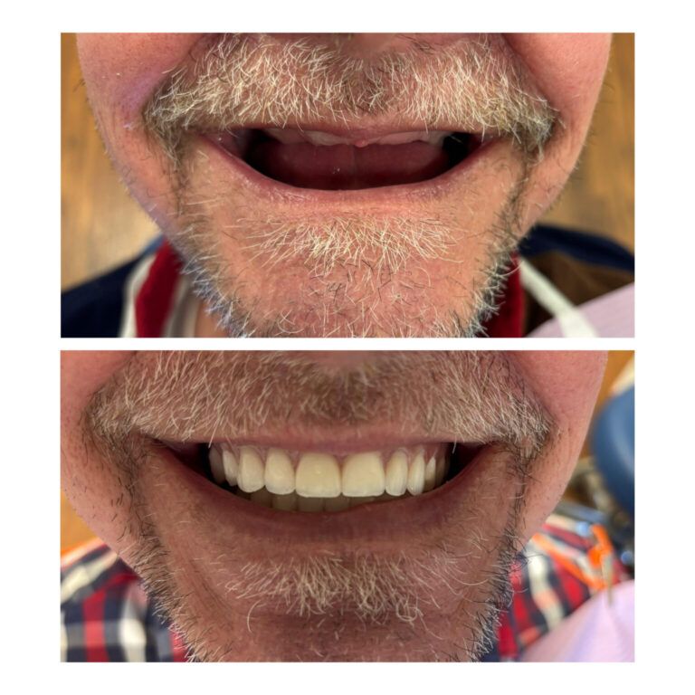 Complete Dentures