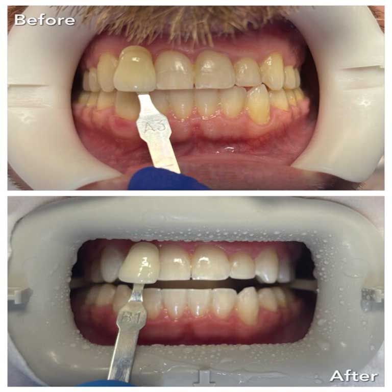teeth bleaching