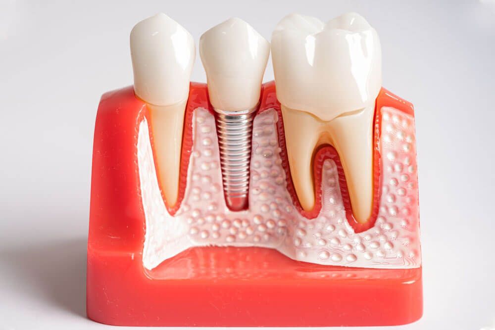 Dental implant, artificial tooth roots into jaw