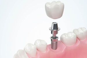 white tooth and gum with Dental implant ,