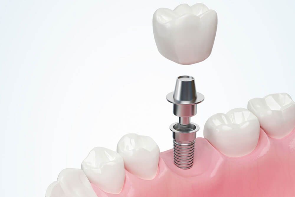 white tooth and gum with Dental implant ,