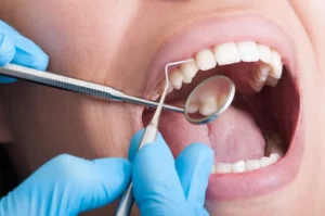 Periodontal-Scaling-Root-Planing