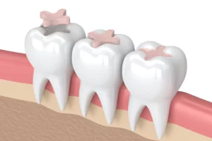 3d render of teeth with dental inlay filling in gums