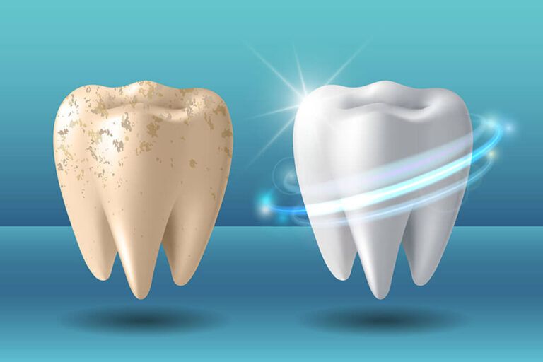 Teeth whitening 3d concept