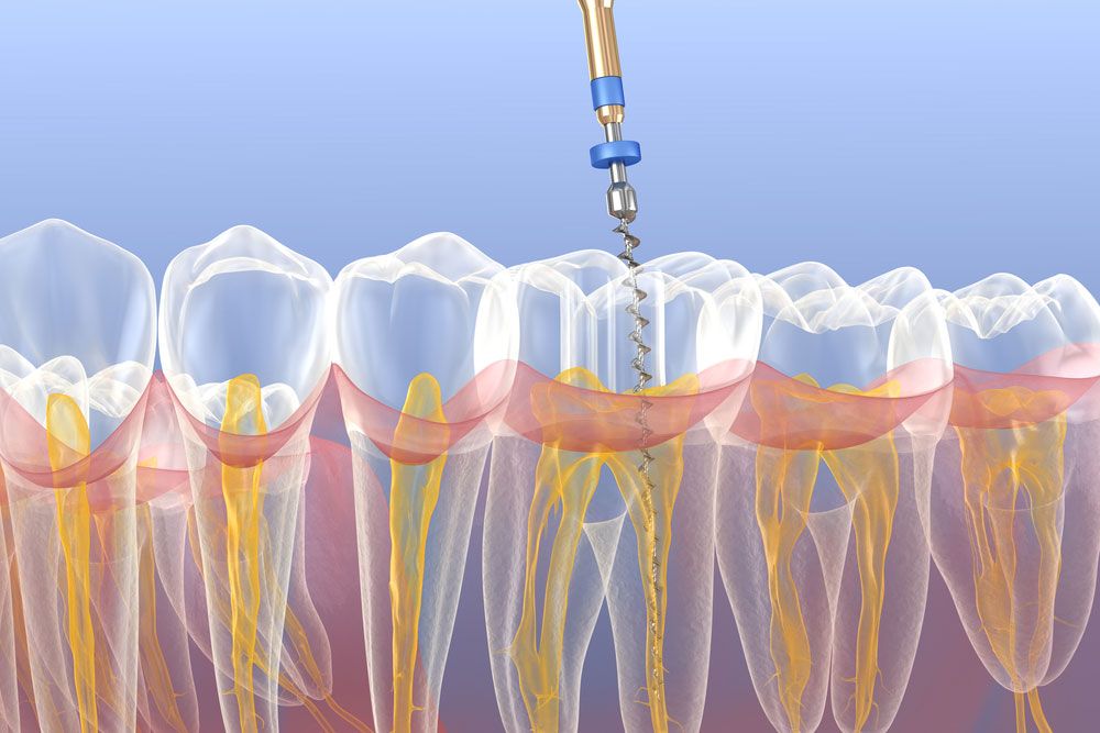 Endodontic root canal treatment process