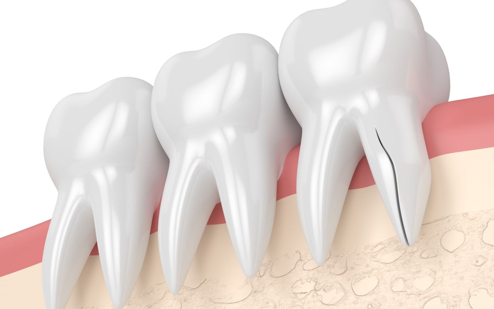 Understanding Vertical Root Fractures: Diagnosis and Treatment at ...