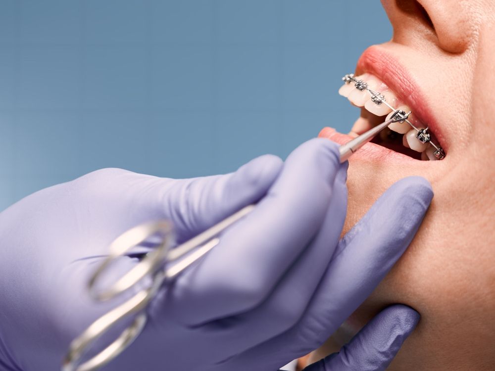 Woman with wired metal braces on teeth receiving orthodontic treatment.Hands of doctor wearing sterile gloves isolated on a Blue background.