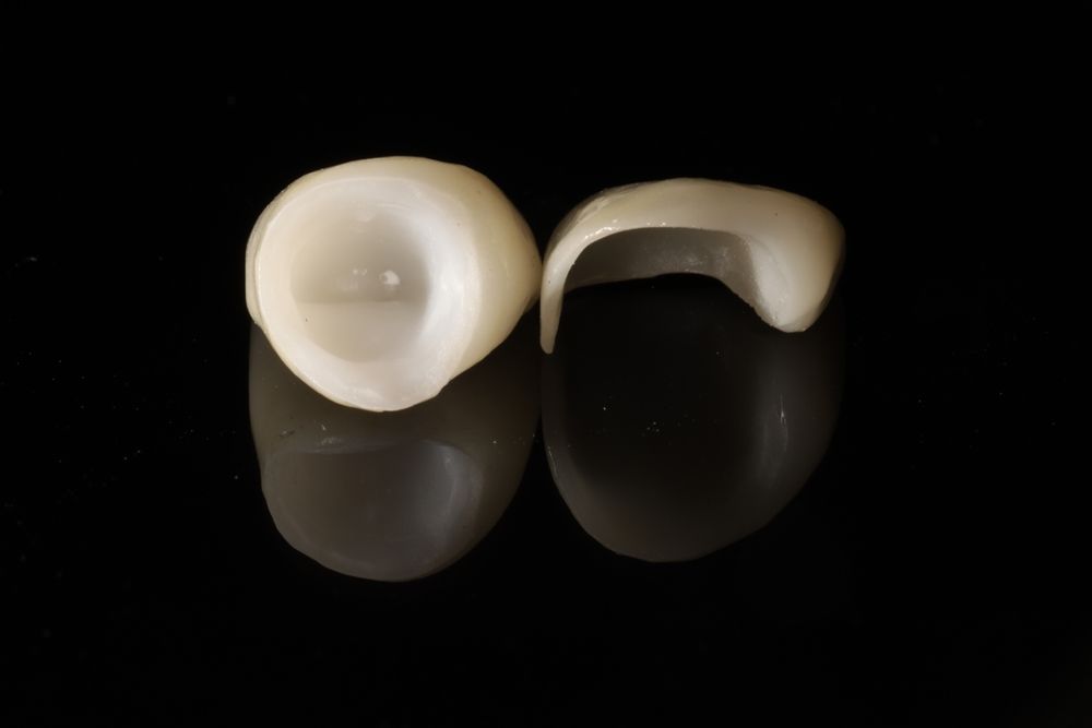 Dental crowns and veneers in a close-up view