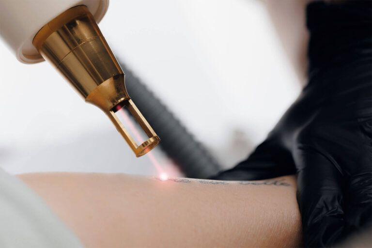 laser tattoo removal from woman hand