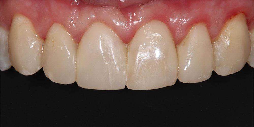 After Smile Improvement with Composite Treatment