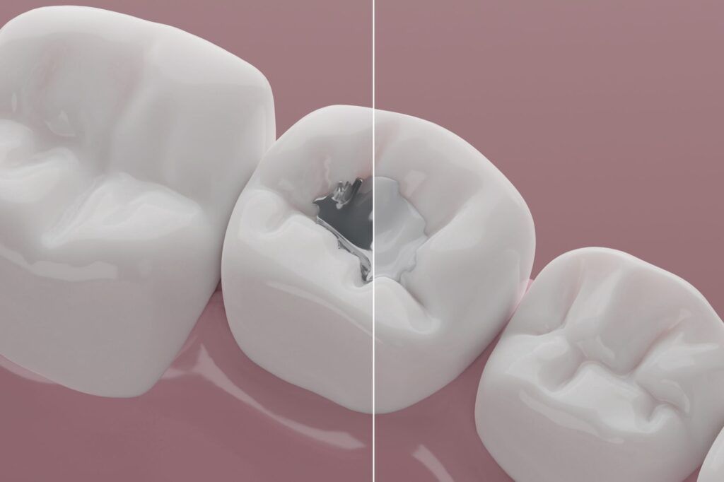 Composite Fillings