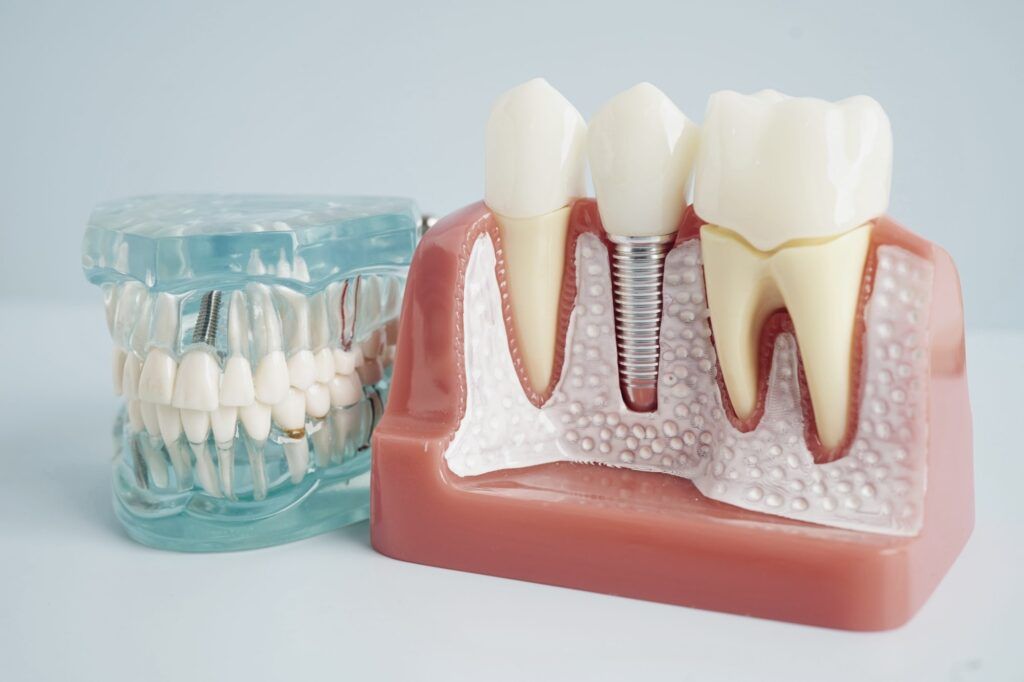 artificial tooth roots into jaw