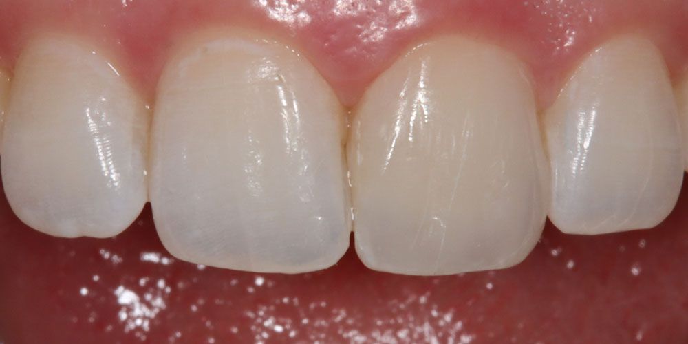 After Fractured Tooth Repair Treatment