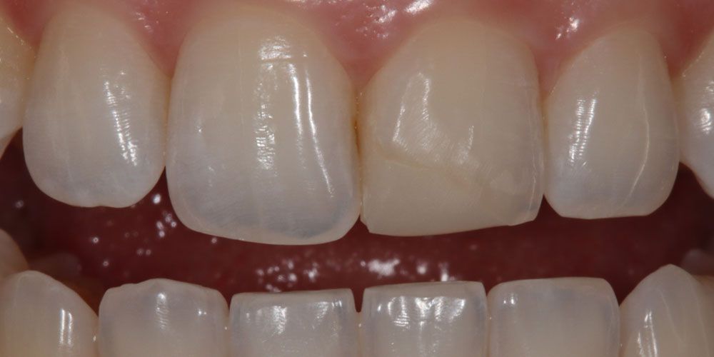 Before Fractured Tooth Repair Treatment