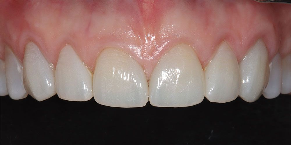 After Ceramic Crowns & Veneers Treatment