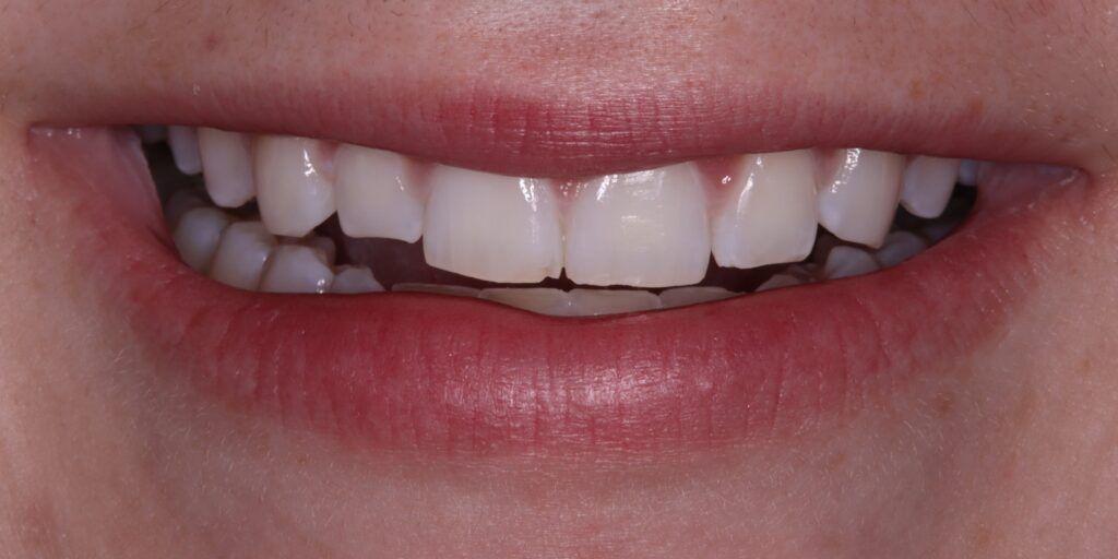 Before Smile Improvement with Composite Treatment