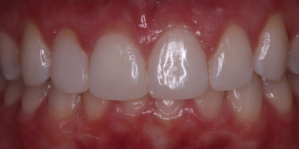 After Smile Improvement with Composite Treatment