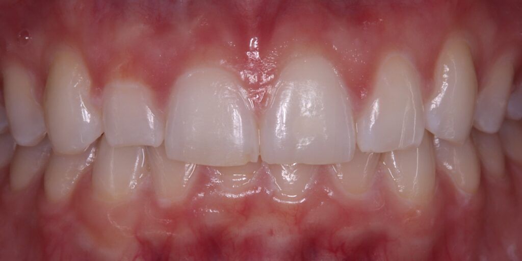 Before Smile Improvement with Composite Treatment