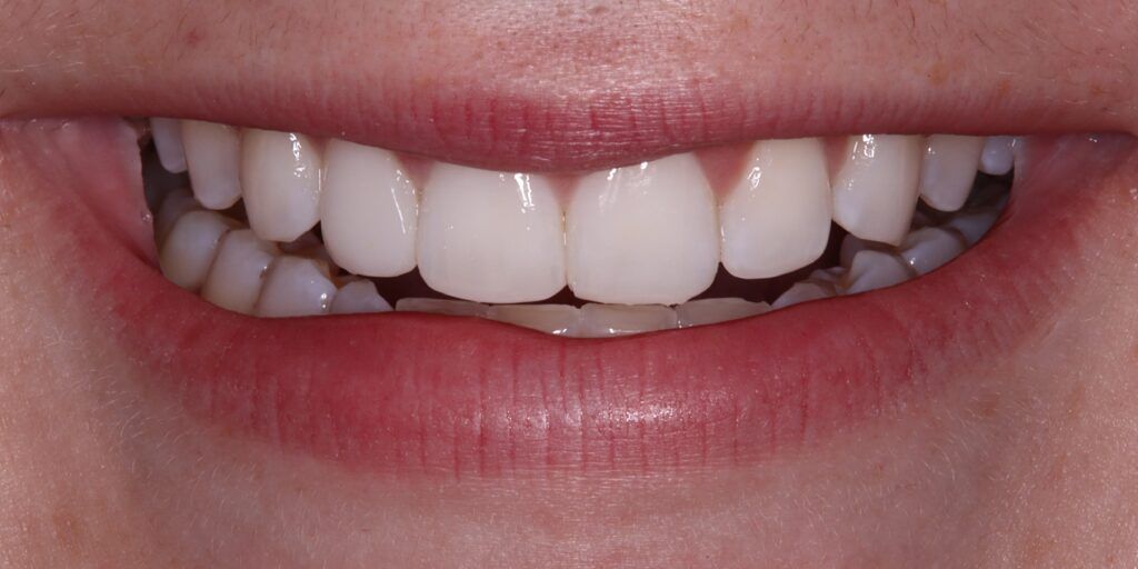 After Smile Improvement with Composite Treatment