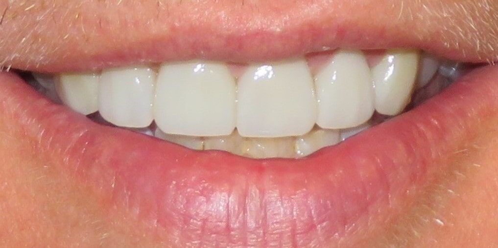 After Ceramic Crowns & Veneers Treatment