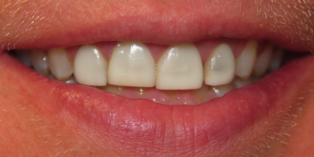 Before Ceramic Crowns & Veneers