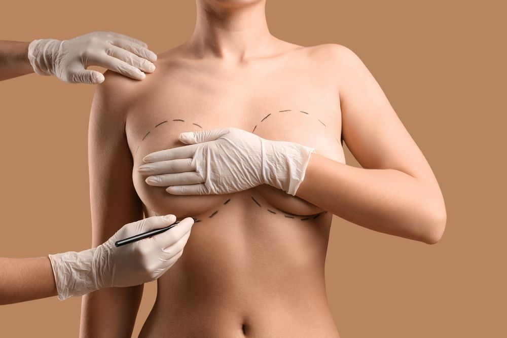 Plastic,Surgeon,Marking,Woman's,Breast,On,Brown,Background,,Closeup