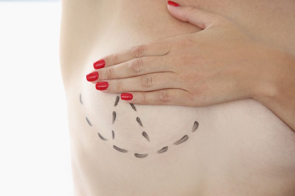 Preoperative,Markings,Are,Drawn,On,Woman,Mammary,Gland,In,Black