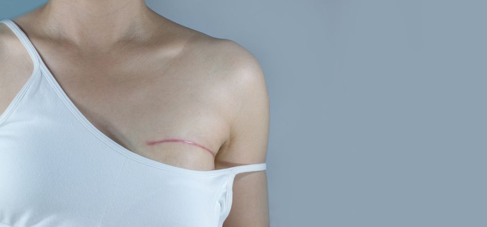 Breast,Cancer,Surgery,Scars,By,Partial,Mastectomy.,She,Can,Wear